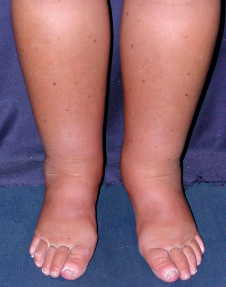 linfedema cos'è