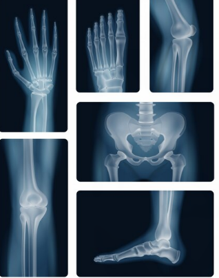 Frattura delle dita della mano: Diagnosi e Trattamento